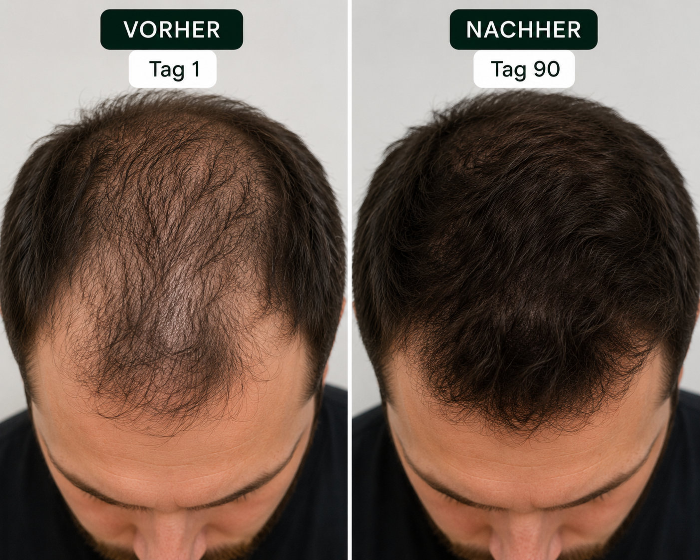 Vorher/Nachher — Person 2: Haardichte, Tag 1 vs. Tag 90
